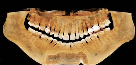 Ejemplo de reconstrucción CBCT 3D usada para planificación de implantes en Cherish Dental